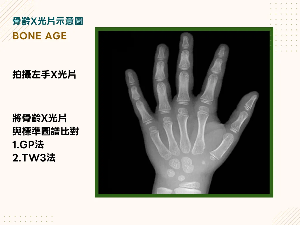 大花醫師骨齡評估說明：兒童左手掌與手腕 X 光片，可見長骨、短骨與腕骨的成熟度