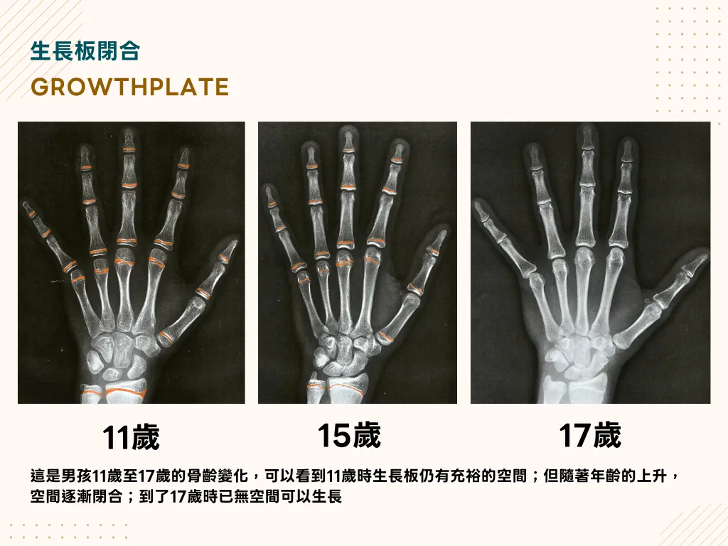 男孩手部 X 光從 11 歲到 17 歲的骨齡變化